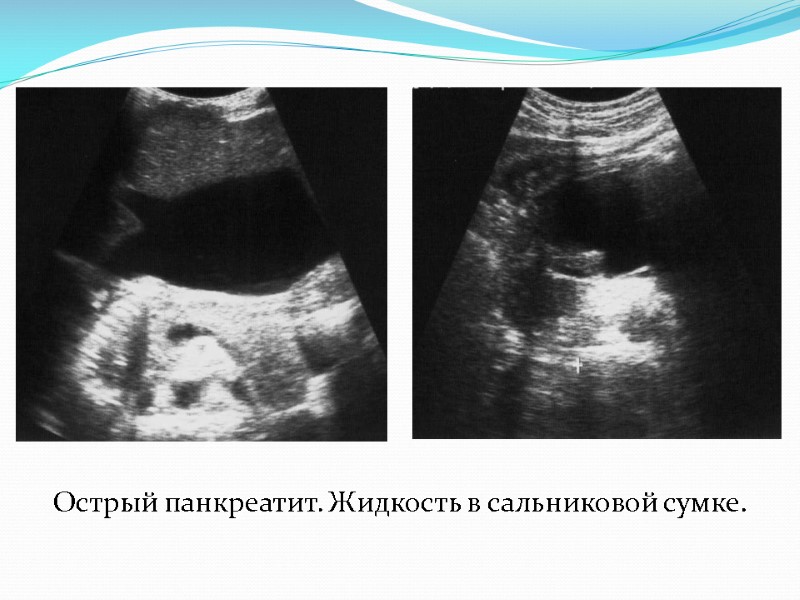 Острый панкреатит. Жидкость в сальниковой сумке.